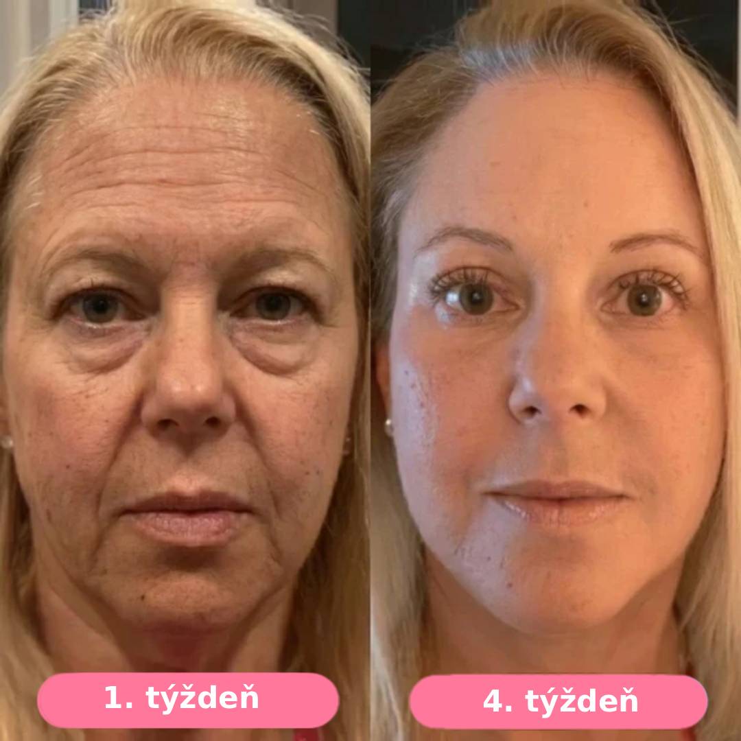 Serum Collagen